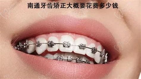 公布最新种植牙品牌及价格，5000元的种植牙能用几年？ - 知乎