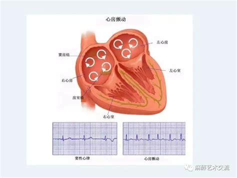 心室颤动心电图图片,心室颤动心电图,房颤心电图图片(第11页)_大山谷图库
