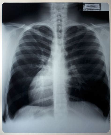 _正常肺部与肺纤维化X线对比图片_有来医生
