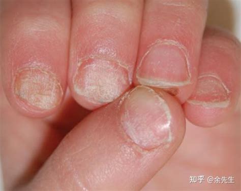 灰指甲症状图片是什么样子_灰指甲_北京京城皮肤医院(北京医保定点机构)