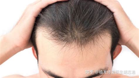 植发后的头发生长过程你知道吗？长沙植发技术好不好？_凤凰网健康_凤凰网