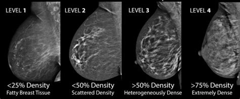 乳腺癌的疾病介绍 | 挂号网
