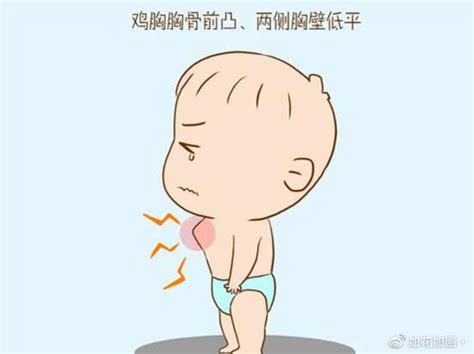 鸡胸患者图片