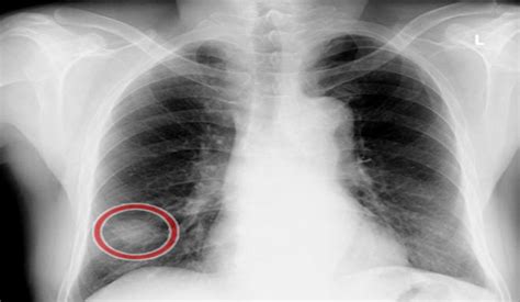 病例132 中央型肺癌(三)-X线读片-医学
