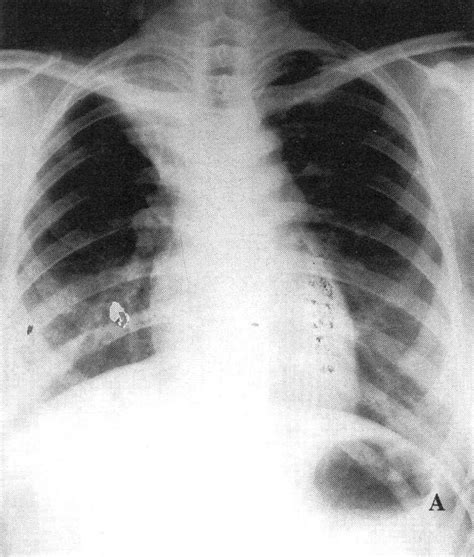 图2—24 支气管结核合并右上叶不张-特种医学-医学