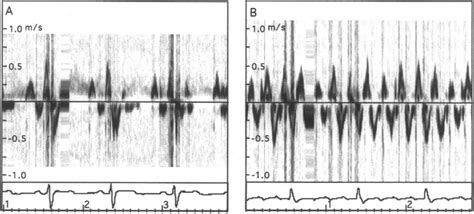 Left atrial appendage flow velocity profile in sinus rhythm (A) and in ...
