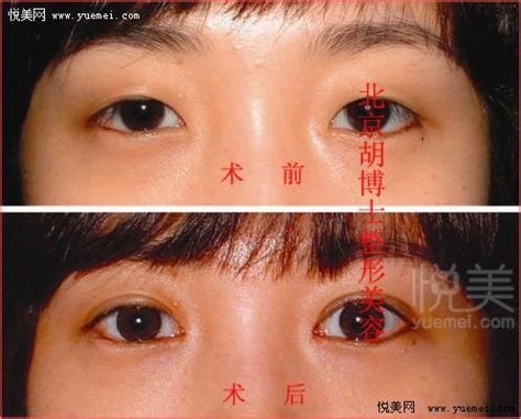 【图】双眼皮失败的八种表现是什么 了解这些你才能做出选择_眼皮_女物美容网|nvwu.com