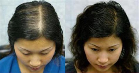 脱发药物治疗和头发种植哪个好?_上海美莱医疗美容