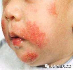 小孩出疹子图片