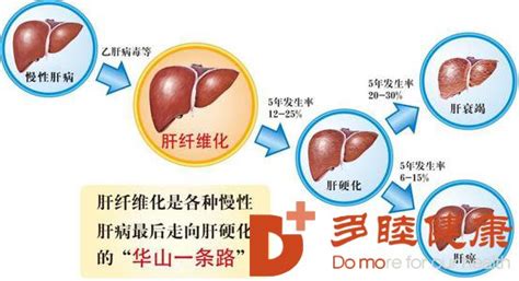 肝硬化图片