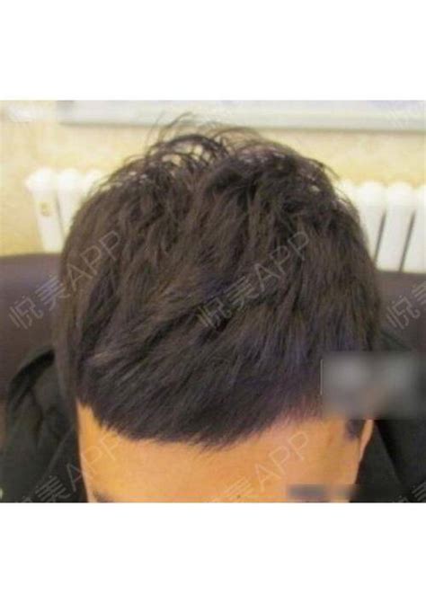 种植头发的危害 种植头发有哪些副作用