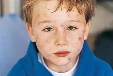 婴儿脸上起红疹子怎么办（孩子脸上长红疹是什么病因）-幼儿百科-魔术铺