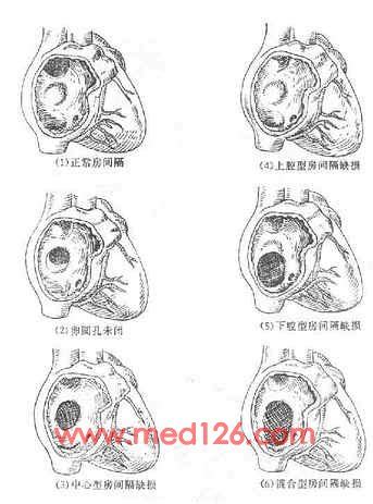 胎儿心脏室间隔缺损1.4毫米