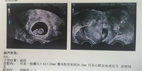 怀孕三四天能看到孕囊吗