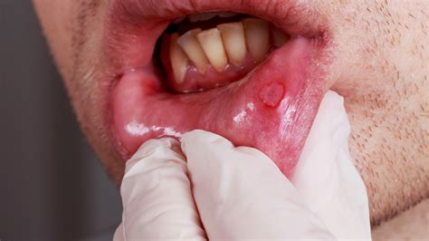 经常口腔溃疡可以预防吗