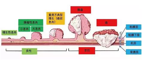 什么症状需要做肠镜