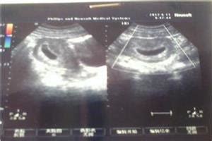怀孕胎儿横位是男孩还是女孩