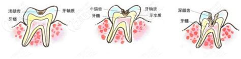 奶根发硬还疼怎么回事