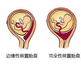 胎儿着床位置图解