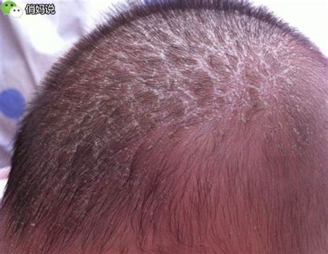 囟门闭合早的宝宝聪明