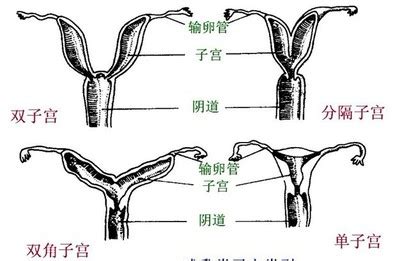 子宫畸形会影响生育吗