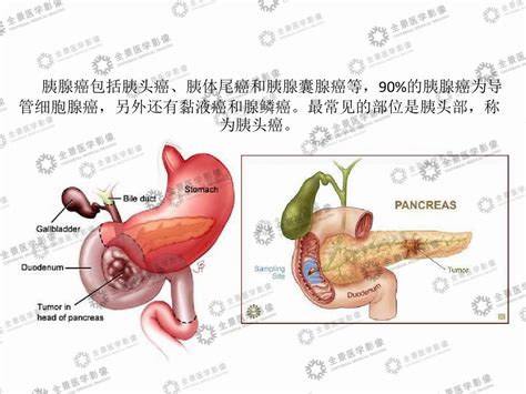 胰腺的位置图片