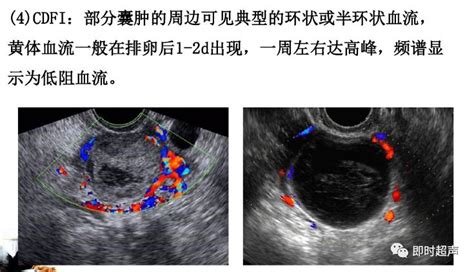 黄体囊肿做手术要多少钱