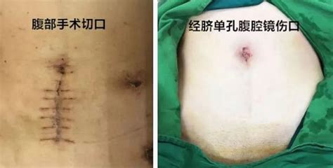 35岁了还能剖腹产3胎吗