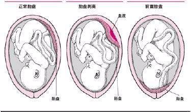 生孩子对子宫前后位的影响