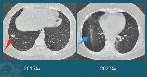 陳舊性肺結核可以喝駝駱奶嗎