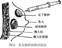 哺乳期乳腺炎的症状有哪些