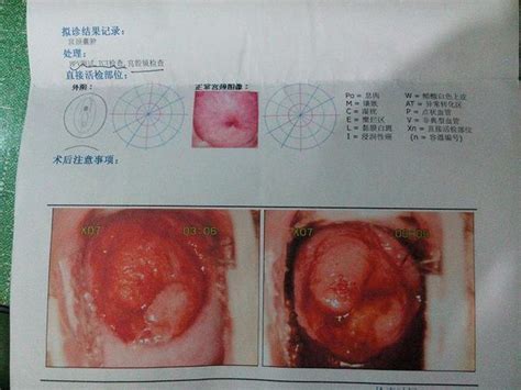 tct和hpv检查什么时候可以出结果