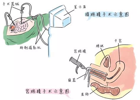 宫腔息肉多大会影响怀孕