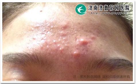 满脸痘痘是怎么回事该怎么治疗