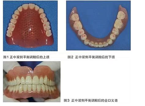 牙齿取模需要多久时间