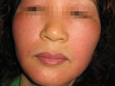 过敏性皮炎禁忌吃什么