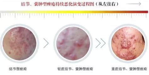 吃达英35治痤疮多久能好