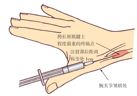 白醋加艾叶治腱鞘炎