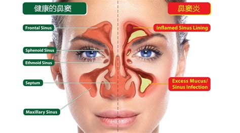 怎样治流鼻涕效果最快偏方