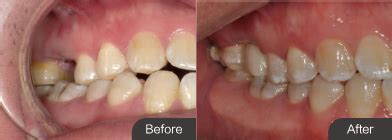 种植牙的过程有几个步骤时间