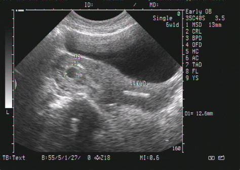 怀孕8个月b超图分析