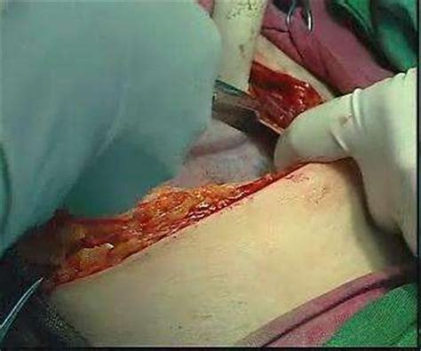 生孩子顺产疼还是剖腹产疼