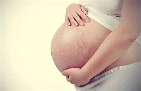 妊娠纹孕期可以完全避免吗