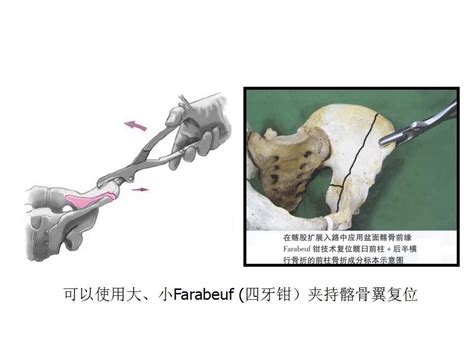 髋臼骨折十一周