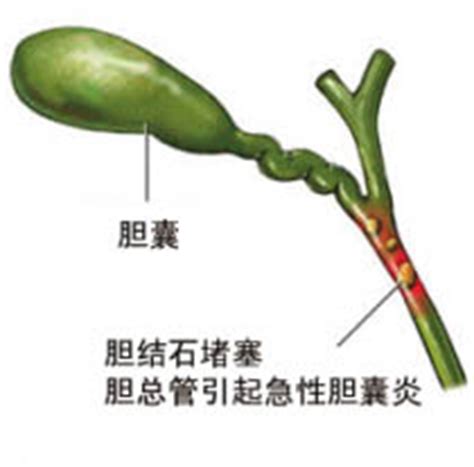 胆结石可以吃方便面吗