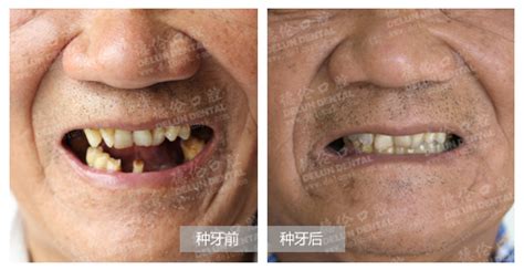 老人戴活动假牙的利弊