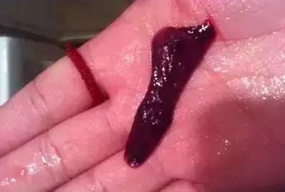 引产后血块怎么排出来
