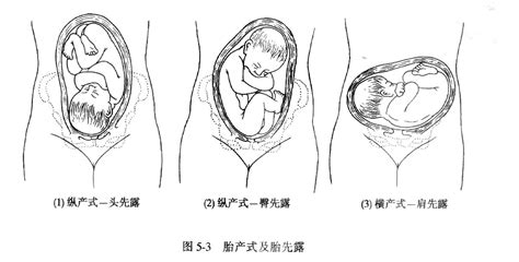 37周胎位不正矫正方法