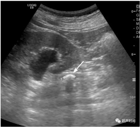 b超能查肾的什么