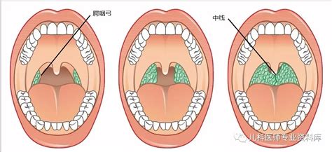 扁桃体肿大怎么治